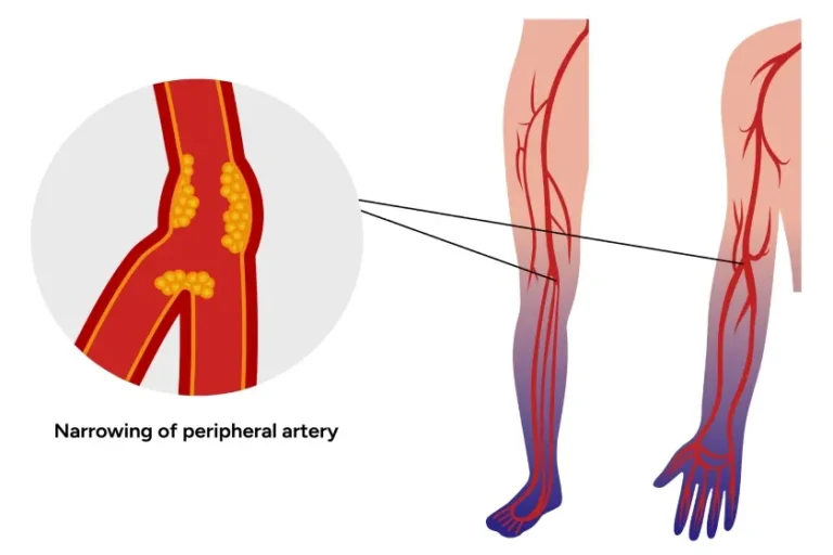 Peripheral Arterial Disease